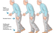 Dùng thuốc điều trị bệnh Parkinson cần lưu ý những gì?