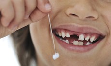 4 biện pháp phòng sún răng cho trẻ cha mẹ cần biết
