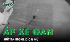 Áp xe gan hút ra 500ml dịch mủ