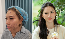 Viện Thẩm mỹ SIAM THAILAND ra mắt công nghệ cấy mỡ mặt trẻ hóa