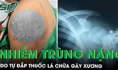 Nhiễm trùng nặng do đắp lá chữa gãy xương