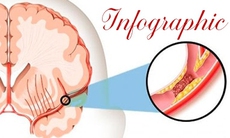 [Infographic] Bác sĩ cảnh báo những thói quen hàng ngày gây thiếu máu não