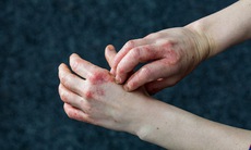 8 thủ phạm phổ biến gây viêm da tiếp xúc