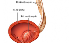 Đau tức bụng, vùng thắt lưng, tiểu khó… thận trọng với bệnh lý thận - niệu quản đôi