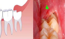 Nhận biết và xử trí răng khôn mọc lệch