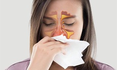 Thuốc gì trị viêm mũi dị ứng?
