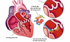 Ngăn ngừa biến chứng viêm nội tâm mạc nhiễm khuẩn