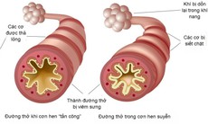 Giải pháp hỗ trợ cải thiện ho, khò khè, khó thở từ thảo dược