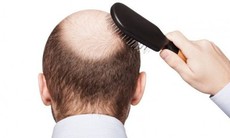Phối hợp thuốc điều trị hiệu quả chứng rụng tóc từng mảng