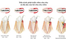 Các phương pháp điều trị viêm nha chu