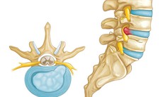 Biểu hiện của thoát vị đĩa đệm, cách điều trị hiệu quả