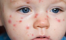 Bệnh thủy đậu ở trẻ: Nguyên nhân, triệu chứng và các biện pháp điều trị