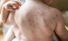 Lựa chọn thuốc điều trị thủy đậu cho trẻ