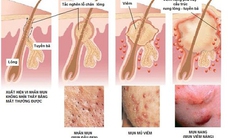 Những điều cần biết về điều trị mụn trứng cá