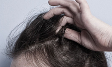 Thuốc trị bệnh Alzheimer có thể làm giảm chứng rối loạn giật tóc