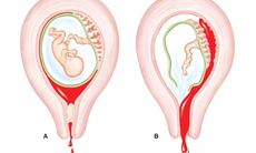 Thai phụ ra huyết âm đạo ồ ạt coi chừng thai bám sẹo mổ cũ