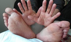7 sai lầm thường gặp khi điều trị tay chân miệng cho trẻ