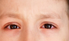Ngứa mắt và đau mắt đỏ có thể là triệu chứng mới của COVID-19