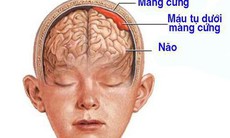 Bị ngã sau 2 tháng mới phát hiện bị tụ máu dưới màng cứng, bệnh nhân phải phẫu thuật khẩn cấp