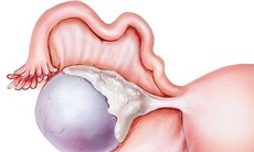 U nang nhầy buồng trứng có nguy hiểm?