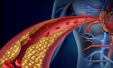 Bệnh mạch vành có thể dẫn đến các cơn nhồi máu cơ tim nguy hiểm