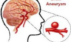 Phát hiện sớm phình động mạch não