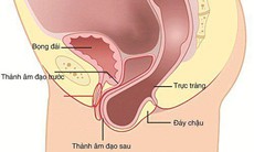 Sa trực tràng dễ nhầm với bệnh gì? Ai hay bị sa trực tràng?