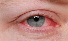 Nguyên nhân gây đau mắt đỏ và cách dùng thuốc điều trị