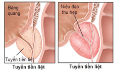 Món ăn bài thuốc hỗ trợ trị viêm tuyến tiền liệt