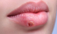 Herpes có chữa khỏi được không?