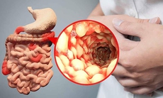 6 cách ngăn chặn sự bùng phát của bệnh Crohn