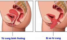 Nguyên nhân gây sa sinh dục và ai có nguy cơ bị sa sinh dục?