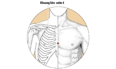 Trị viêm họng mùa hè bằng Đông y