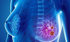 Bệnh nhân ung thư vú giai đoạn đầu đều sống lâu, yếu tố làm tăng nguy cơ tử vong ở người bệnh?