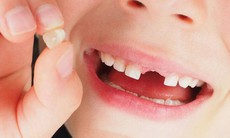 Sơ cứu răng rơi khỏi ổ đúng cách khi gặp tai nạn chấn thương răng