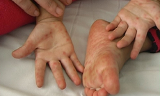 Số ca mắc bệnh tay chân miệng tiếp tục gia tăng ở TP.HCM
