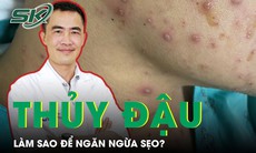 Làm sao để ngăn sẹo sau thủy đậu?