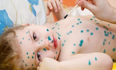 Có nên bôi xanh methylen trị vết loét khi trẻ bị tay chân miệng?