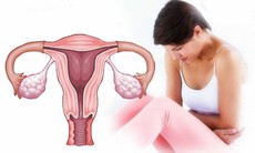 Bất thường ở tử cung ảnh hưởng đến khả năng sinh sản thế nào?