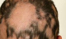 Thêm liệu pháp trị rụng tóc từng mảng cho người lớn và thanh thiếu niên