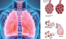 Ai dễ mắc viêm phổi, cần làm gì để chóng hồi phục?
