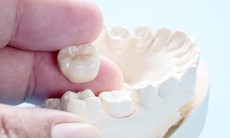 Những ai nên và không nên bọc răng sứ thẩm mỹ?