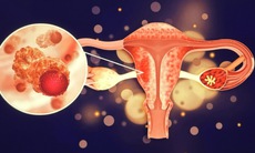 6 dấu hiệu của ung thư buồng trứng dễ bị bỏ qua