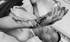 Phẫu thuật khẩn trong đêm cứu bàn tay bị máy cưa nước đá nghiền nát
