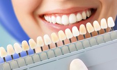 Răng bị ố vàng có tẩy trắng được không?