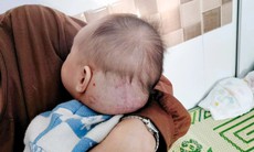 Trẻ 9 tháng tuổi 'đeo' khối u hỗn hợp lớn vùng đầu gáy