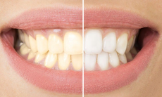 Cách duy trì răng hiệu quả sau khi tẩy trắng