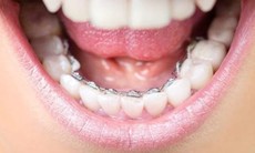 Phương pháp niềng răng nào tối ưu nhất?