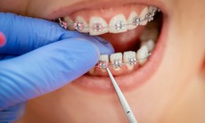 Cần lưu ý gì trước và sau khi niềng răng?