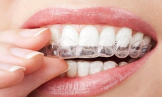 Ưu và nhược điểm của các phương pháp niềng răng